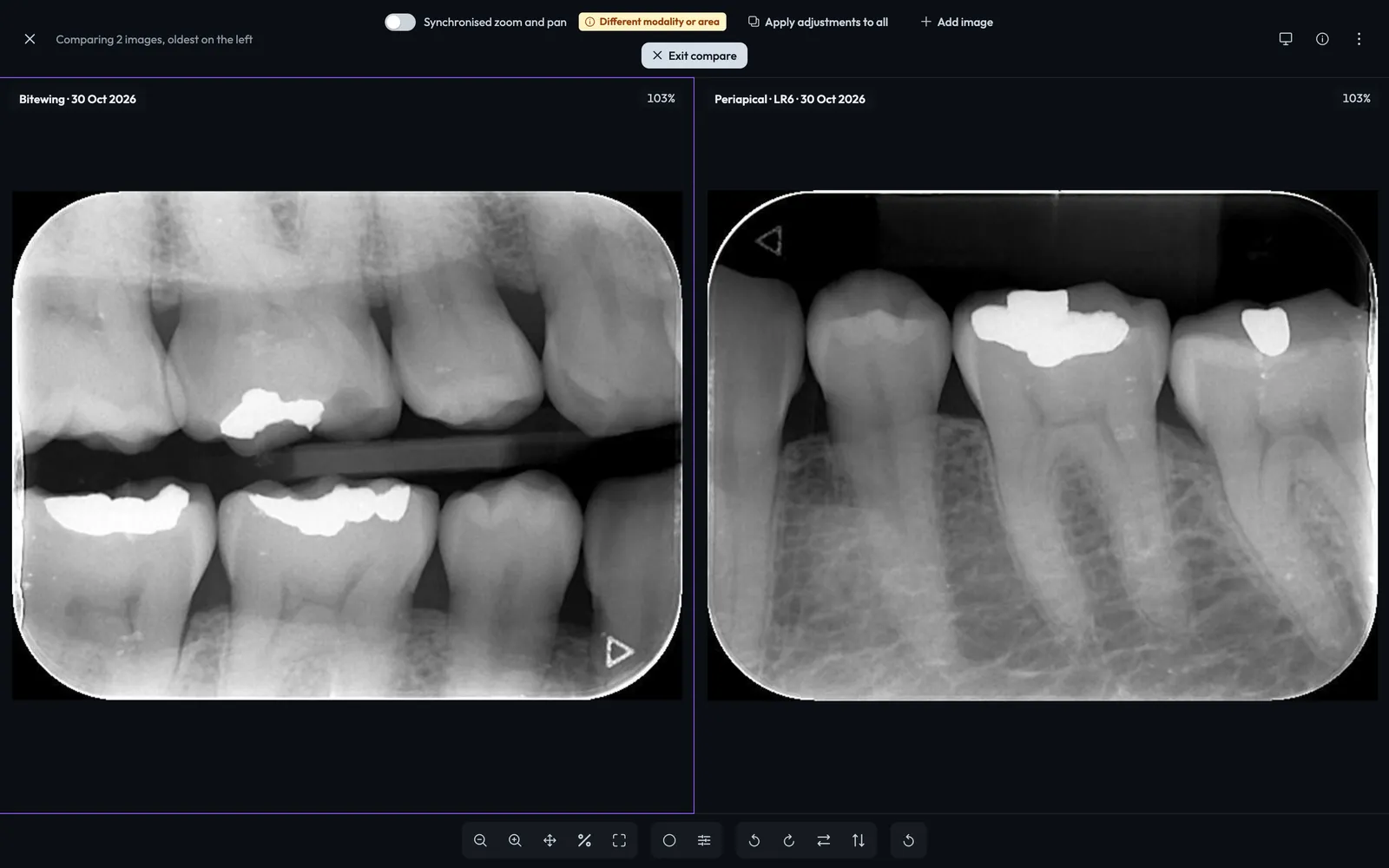 A bitewing and a periapical of the lower right first molar side by side in the viewer's compare mode, oldest on the left.