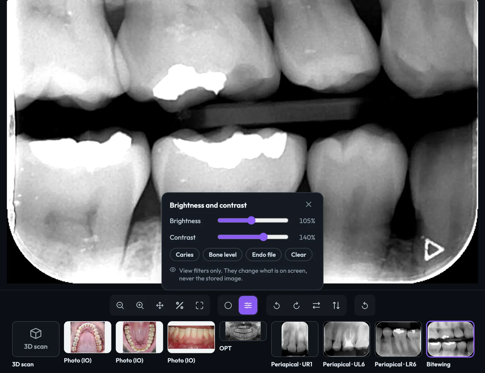 A bitewing in the viewer with the Caries preset applied, the Brightness and contrast panel open and the patient's X-rays, photos and 3D scan in the strip below.